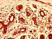 IHC image of CSB-PA022787LA01HU diluted at 1:300 and staining in paraffin-embedded human breast cancer performed on a Leica BondTM system. After dewaxing and hydration, antigen retrieval was mediated by high pressure in a citrate buffer (pH 6.0)....