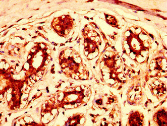 IHC image of CSB-PA022787LA01HU diluted at 1:300 and staining in paraffin-embedded human breast cancer performed on a Leica BondTM system. After dewaxing and hydration, antigen retrieval was mediated by high pressure in a citrate buffer (pH 6.0)....
