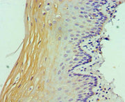 Immunohistochemistry of paraffin-embedded human cervical cancer using CSB-PA022813ESR1HU at dilution of 1:100