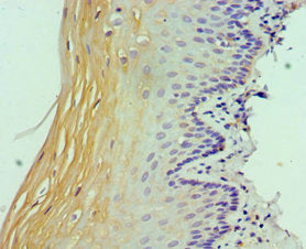 Immunohistochemistry of paraffin-embedded human cervical cancer using CSB-PA022813ESR1HU at dilution of 1:100