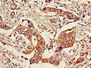 Immunohistochemistry of paraffin-embedded human pancreatic cancer using CSB-PA022816LA01HU at dilution of 1:100