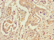 Immunohistochemistry of paraffin-embedded human pancreatic cancer using CSB-PA022885LA01HU at dilution of 1:100