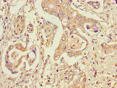 Immunohistochemistry of paraffin-embedded human pancreatic cancer using CSB-PA022885LA01HU at dilution of 1:100