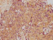 IHC image of CSB-PA022888LA01HU diluted at 1:500 and staining in paraffin-embedded human ovarian cancer performed on a Leica BondTM system. After dewaxing and hydration, antigen retrieval was mediated by high pressure in a citrate buffer (pH 6.0)....