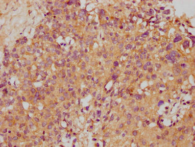 IHC image of CSB-PA022888LA01HU diluted at 1:500 and staining in paraffin-embedded human ovarian cancer performed on a Leica BondTM system. After dewaxing and hydration, antigen retrieval was mediated by high pressure in a citrate buffer (pH 6.0)....