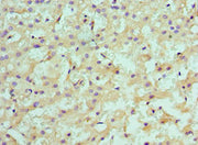 Immunohistochemistry of paraffin-embedded human liver cancer using CSB-PA022942ESR1HU at dilution of 1:100