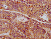 IHC image of CSB-PA022980LA01HU diluted at 1:300 and staining in paraffin-embedded human endometrial cancer performed on a Leica BondTM system. After dewaxing and hydration, antigen retrieval was mediated by high pressure in a citrate buffer (pH 6...