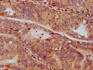 IHC image of CSB-PA022980LA01HU diluted at 1:300 and staining in paraffin-embedded human endometrial cancer performed on a Leica BondTM system. After dewaxing and hydration, antigen retrieval was mediated by high pressure in a citrate buffer (pH 6...