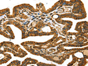 The image on the left is immunohistochemistry of paraffin-embedded Human thyroid cancer tissue using CSB-PA022994(STX11 Antibody) at dilution 1/30, on the right is treated with fusion protein. (Original magnification: ×200)