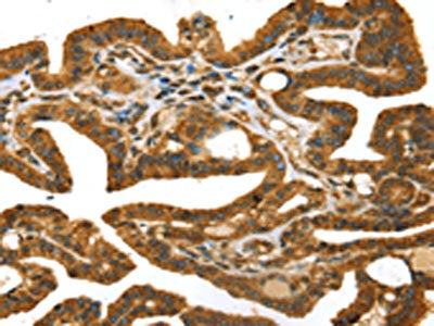 The image on the left is immunohistochemistry of paraffin-embedded Human thyroid cancer tissue using CSB-PA022994(STX11 Antibody) at dilution 1/30, on the right is treated with fusion protein. (Original magnification: ×200)