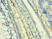 Immunohistochemistry of paraffin-embedded human colon cancer using CSB-PA023093ESR1HU at dilution of 1:100