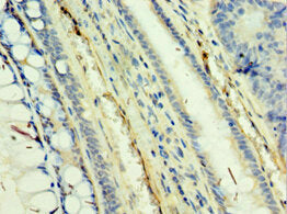 Immunohistochemistry of paraffin-embedded human colon cancer using CSB-PA023093ESR1HU at dilution of 1:100