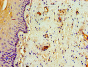 Immunohistochemistry of paraffin-embedded human cervical cancer using CSB-PA023120ESR1HU at dilution of 1:100
