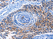 The image on the left is immunohistochemistry of paraffin-embedded Human esophagus cancer tissue using CSB-PA023160(CLEC2B Antibody) at dilution 1/50, on the right is treated with fusion protein. (Original magnification: ×200)