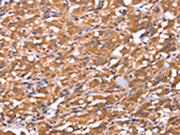 The image on the left is immunohistochemistry of paraffin-embedded Human thyroid cancer tissue using CSB-PA023220(FAM13B Antibody) at dilution 1/20, on the right is treated with synthetic peptide. (Original magnification: ×200)