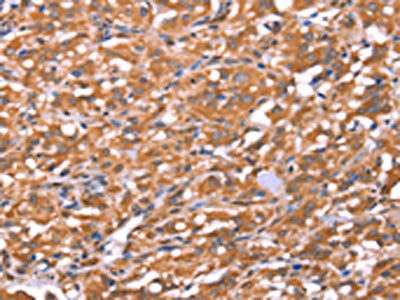The image on the left is immunohistochemistry of paraffin-embedded Human thyroid cancer tissue using CSB-PA023220(FAM13B Antibody) at dilution 1/20, on the right is treated with synthetic peptide. (Original magnification: ×200)