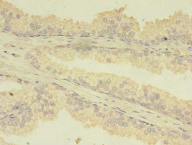 Immunohistochemistry of paraffin-embedded human prostate cancer using CSB-PA023225HA01HU at dilution of 1:100