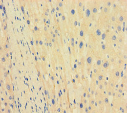 Immunohistochemistry of paraffin-embedded human liver cancer using CSB-PA023240LA01HU at dilution of 1:100
