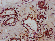IHC image of CSB-PA023271LA01HU diluted at 1:600 and staining in paraffin-embedded human breast cancer performed on a Leica BondTM system. After dewaxing and hydration, antigen retrieval was mediated by high pressure in a citrate buffer (pH 6.0)....