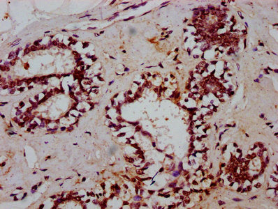 IHC image of CSB-PA023271LA01HU diluted at 1:600 and staining in paraffin-embedded human breast cancer performed on a Leica BondTM system. After dewaxing and hydration, antigen retrieval was mediated by high pressure in a citrate buffer (pH 6.0)....