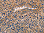 The image on the left is immunohistochemistry of paraffin-embedded Human liver cancer tissue using CSB-PA023292(ADAMDEC1 Antibody) at dilution 1/20, on the right is treated with fusion protein. (Original magnification: ×200)