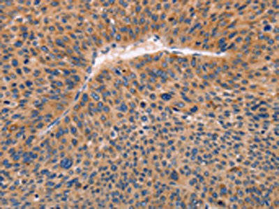 The image on the left is immunohistochemistry of paraffin-embedded Human liver cancer tissue using CSB-PA023292(ADAMDEC1 Antibody) at dilution 1/20, on the right is treated with fusion protein. (Original magnification: ×200)