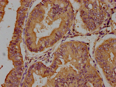 IHC image of CSB-PA023309OA01HU diluted at 1:100 and staining in paraffin-embedded human endometrial cancer performed on a Leica BondTM system. After dewaxing and hydration, antigen retrieval was mediated by high pressure in a citrate buffer (pH 6...