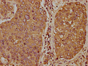IHC image of CSB-PA023314LA01HU diluted at 1:400 and staining in paraffin-embedded human liver cancer performed on a Leica BondTM system. After dewaxing and hydration, antigen retrieval was mediated by high pressure in a citrate buffer (pH 6.0). S...