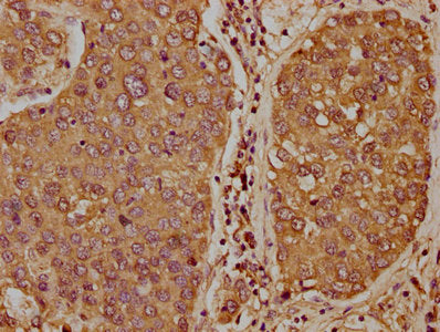 IHC image of CSB-PA023314LA01HU diluted at 1:400 and staining in paraffin-embedded human liver cancer performed on a Leica BondTM system. After dewaxing and hydration, antigen retrieval was mediated by high pressure in a citrate buffer (pH 6.0). S...