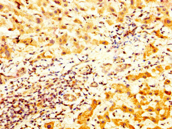 IHC image of CSB-PA023320LA01HU diluted at 1:800 and staining in paraffin-embedded human liver cancer performed on a Leica BondTM system. After dewaxing and hydration, antigen retrieval was mediated by high pressure in a citrate buffer (pH 6.0). S...