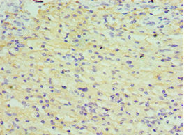 Immunohistochemistry of paraffin-embedded human colon cancer using CSB-PA023343ESR2HU at dilution of 1:100
