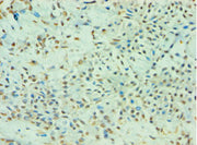 Immunohistochemistry of paraffin-embedded human breast cancer using CSB-PA023352ESR2HU at dilution of 1:100