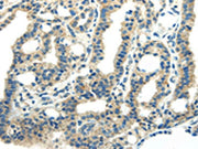 The image on the left is immunohistochemistry of paraffin-embedded Human thyroid cancer tissue using CSB-PA023390(PDPN Antibody) at dilution 1/25, on the right is treated with synthetic peptide. (Original magnification: ×200)