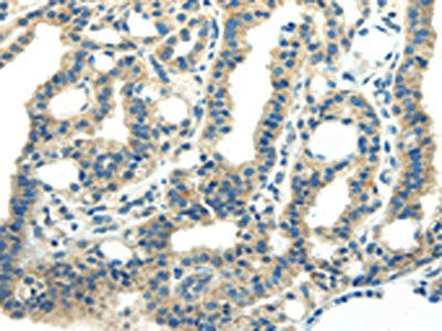 The image on the left is immunohistochemistry of paraffin-embedded Human thyroid cancer tissue using CSB-PA023390(PDPN Antibody) at dilution 1/25, on the right is treated with synthetic peptide. (Original magnification: ×200)