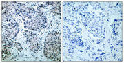 Immunohistochemical analysis of paraffin-embedded human breast carcinoma tissue using SEK1/MKK4(Phospho-Thr261) Antibody(left) or the same antibody preincubated with blocking peptide(right).