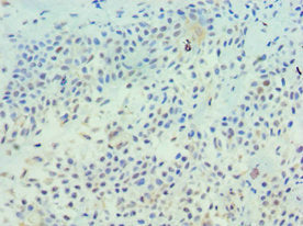 Immunohistochemistry of paraffin-embedded human breast cancer using CSB-PA023431DSR2HU at dilution of 1:100