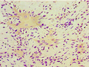 Immunohistochemistry of paraffin-embedded human breast cancer using CSB-PA023462ESR1HU at dilution of 1:100