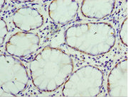 Immunohistochemistry of paraffin-embedded human colon cancer using CSB-PA023489ESR2HU at dilution of 1:100