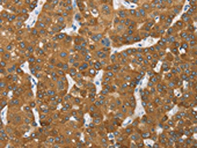 The image on the left is immunohistochemistry of paraffin-embedded Human liver cancer tissue using CSB-PA023517(ENTPD5 Antibody) at dilution 1/20, on the right is treated with fusion protein. (Original magnification: ×200)