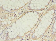 Immunohistochemistry of paraffin-embedded human colon cancer using CSB-PA023548LA01HU at dilution of 1:100