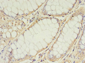Immunohistochemistry of paraffin-embedded human colon cancer using CSB-PA023548LA01HU at dilution of 1:100