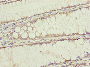 Immunohistochemistry of paraffin-embedded human colon cancer using CSB-PA023551ESR1HU at dilution of 1:100
