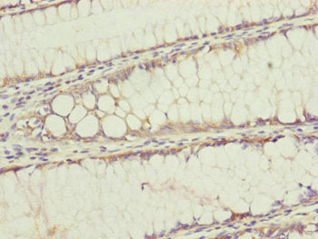 Immunohistochemistry of paraffin-embedded human colon cancer using CSB-PA023551ESR1HU at dilution of 1:100