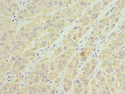 Immunohistochemistry of paraffin-embedded human liver cancer using CSB-PA023557ESR2HU at dilution of 1:100