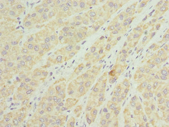 Immunohistochemistry of paraffin-embedded human liver cancer using CSB-PA023557ESR2HU at dilution of 1:100