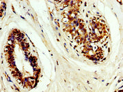 IHC image of CSB-PA023562LA01HU diluted at 1:200 and staining in paraffin-embedded human breast cancer performed on a Leica BondTM system. After dewaxing and hydration, antigen retrieval was mediated by high pressure in a citrate buffer (pH 6.0)....
