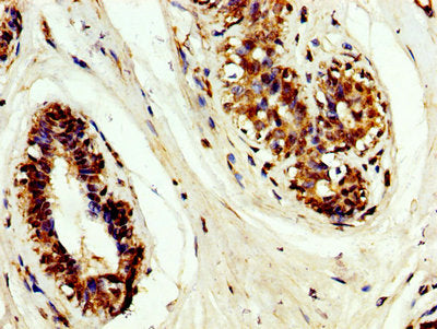 IHC image of CSB-PA023562LA01HU diluted at 1:200 and staining in paraffin-embedded human breast cancer performed on a Leica BondTM system. After dewaxing and hydration, antigen retrieval was mediated by high pressure in a citrate buffer (pH 6.0)....