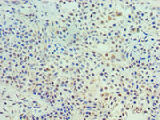 Immunohistochemistry of paraffin-embedded human breast cancer using CSB-PA023577ESR2HU at dilution of 1:100