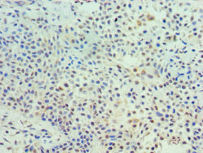 Immunohistochemistry of paraffin-embedded human breast cancer using CSB-PA023577ESR2HU at dilution of 1:100