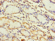 Immunohistochemistry of paraffin-embedded human gastric cancer using CSB-PA023599LA01HU at dilution of 1:100